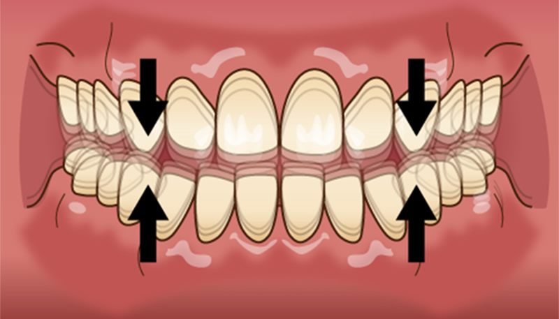歯を鳴らす：タッピングの症状は？